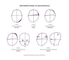 Image result for Positional Head Deformity