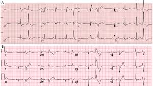 Premature ventricular contractions (pvc) are premature heartbeats originating from the ventricles of the heart. Premature Ventricular Contractions Circulation