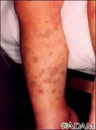 Children may develop itp after a viral infection and usually recover fully without treatment. Purpura Information Mount Sinai New York