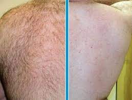 Once back and shoulder hair are removed, manage it once a week. Laser Hair Removal Not Just For Women Time To Step Up Men