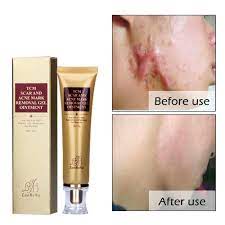 Bioaqua face skin care acne treatment removal cream spots scar blemish. Pin On Best Acne Treatment