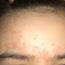 Die ursachen eines exanthems können vielfältig sein. Was Ist Das Fur Ein Ausschlag An Meiner Stirn Gesundheit Und Medizin