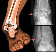 Image result for Ankle XRay