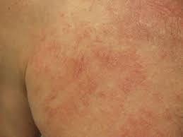 Image result for Generalized Rash