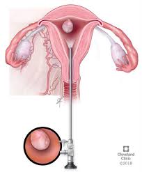 Hysteroscopy Procedure Uses Recovery