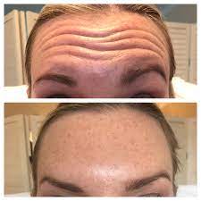 Check spelling or type a new query. The Skin Nurse Botox Treatment For Lines Wrinkles Excessive Sweating
