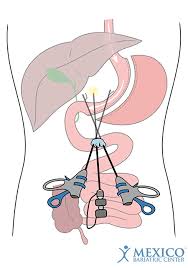 Single Incision Gastric Sleeve Surgery Mexico Bariatric Center You need to activate adobe's flash player to play this. single incision gastric sleeve surgery