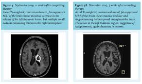 There are more than 300 types of primary immunodeficiency disorders, and researchers continue to identify more. Article Brain Lesions In A Patient With Rectal Cancer Mind Your Step Full Text December 2020 Njm