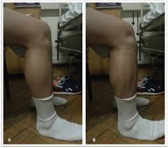 Image result for Lachman Test