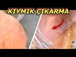How To Remove Wreck Splinter Thorn With Batch Needle Youtube