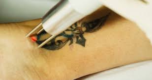 Most infections can be treated by letting the tattoo dry out and carefully washing it. Copenhagen Laser Tattoo Removal Astanza Duality