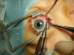 Eye Muscle Treatment India Price Eye Muscle Treatment India