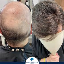 Una domanda che è spesso oggetto di discussione è: Protesi Capelli Come Scegliere L Impianto Giusto Per Te Mondo Parrucche