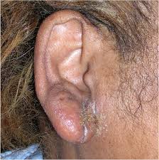 Image result for Acute Otitis Externa