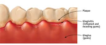 Armandhammer.com has been visited by 10k+ users in the past month Ask The Dentist What Is Plaque What Is Tartar What S The Difference Capstone Dental
