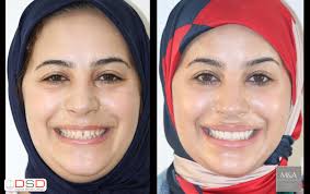 Digital smile design and mock up for treatment plan acceptance