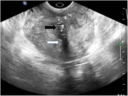 23.05.2012 · transrectal ultrasound (trus) was first developed in the 1970s. Prospective Study On Association Of Prostatic Calcifications With Clinical Symptoms And Results Of Treatment In Men With Type Iii Prostatitis Scientific Reports