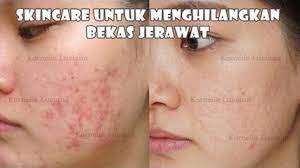 Skii Crim Wajah Untuk Flek Bekas Jerawat Jerawat Wajah Obat Jerawat