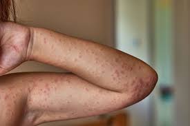Image result for allergy rash on the legs