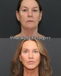 ☀️🌞 4.5 months after surgery! 👸💪 Tina is 66. She lost 110 pounds over  the last 3 years. ⚡️💃 While she feels amazing and energized, her weight  loss accelerated her facial aging