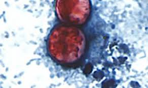 Image result for Cyclospora