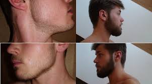 % positive response to minoxidil. How To Use Minoxidil And Rogaine To Grow A Thicker Beard My Man Beard