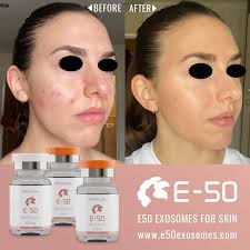 E50 Exosomes Skin and Hair Rejuvenation