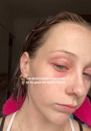 Understanding Eyelid Eczema: Causes and Remedies