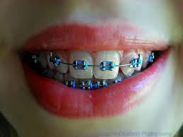Pin By Professional Fangirl On Braces Teeth Braces Braces Colors Getting Braces