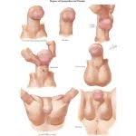 Image result for Chordee