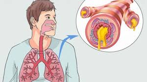 Image result for Acute Bronchitis