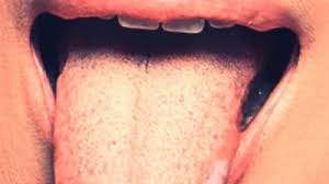 Image result for white cancer on tongue)