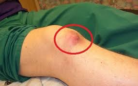 Image result for gout symptoms knee
