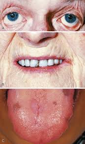 Image result for Anemia simii