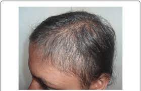 Some people prefer to let their hair loss run its course untreated and unhidden. Right Temporal View Monilethrix New Hair Growth Retained With Less Download Scientific Diagram