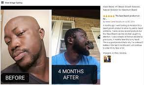 Emu oil benefits hair in many ways. Minoxidil Beard Growth Best Minoxidil Is Not Kirkland Or Rogaine