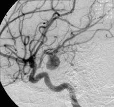 Aortic aneurysms may occur in the chest, called a thoracic aneurysm, or below the stomach, called an abdominal or stomach aneurysm 2. Aneurysm Wikipedia