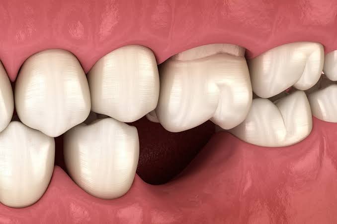Dealing with Loose Adult Teeth: Causes, Risks, and Solutions