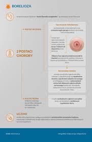 Objawy boreliozy mogą się u różnych osób istotnie różnić. Choroby Odkleszczowe Leczenie Chorob Odkleszczowych