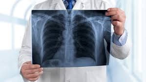 Gefahrliche Lungenentzundung Impfung Empfohlen Ndr De Ratgeber Gesundheit