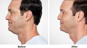 Quick Answer Can Chewing Gum Reduce Double Chin Snozz Cumber