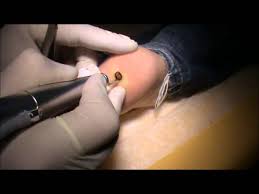 Maybe you would like to learn more about one of these? Belleza Centrum Odstranenie Veruky Bradavice Na Nohe U Dietata Co2 Laserom Youtube