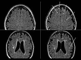Magnetic resonance imaging (mri) has developed into the most important tool for the diagnosis and monitoring of multiple sclerosis (ms). Synthetic Mri Images Are They Valuable For The Evaluation Of Multiple Sclerosis European Radiology