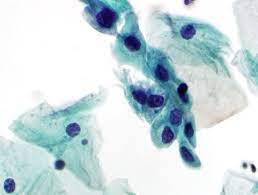 Though koilocytes can be found in lesions in a number of locations, cervical cytology samples, commonly known as pap smears, frequently contain koilocytes. Cytopathology Glowm