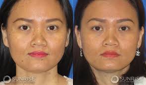 Laser Resurfacing