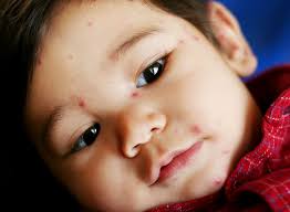 I always had fairly clear skin, but ever since i star. Baby Acne Symptoms How To Treat Baby Acne On Face