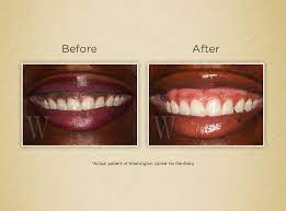 Pin On Before After Gallery