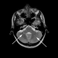 You may feel like you are swirling around in a circle or having objects around you appearing to what does ms feel like in the beginning? Ms And Dizziness