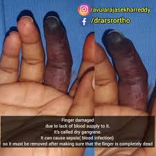 What is sepsis (blood poisoning)? Dry Gangrene Dr Avula Rajasekhar Reddy Ms Orthopaedics Facebook