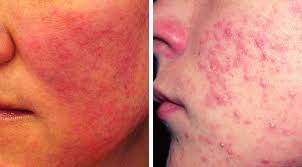 Image result for red rash face